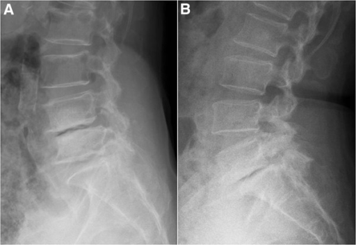 Descripción: Clinical examination revealed 7-mm probing depths, circumferentially around a mandibular implant, bleeding on probing, and the presence of exudate and gingival inflammatory edema